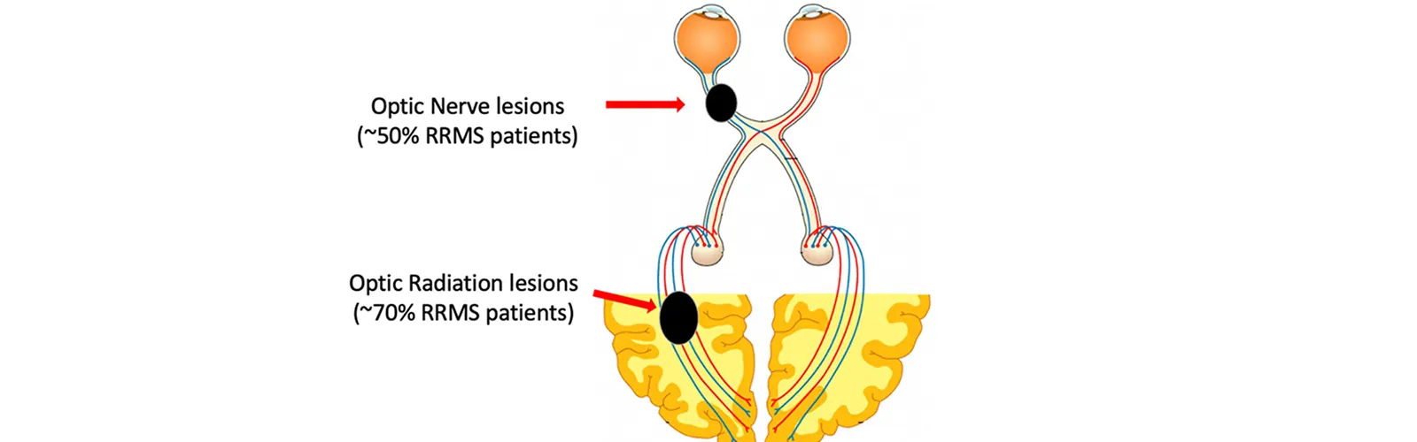 What Are The Limitations Of VEP Test?